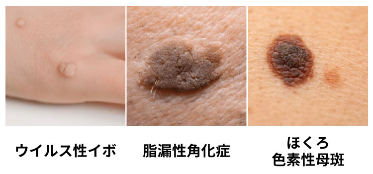 表皮系のできもの